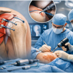 Rotator cuff repair in India